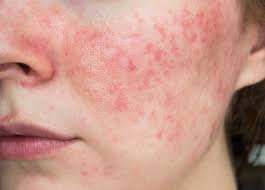 senstive skin image